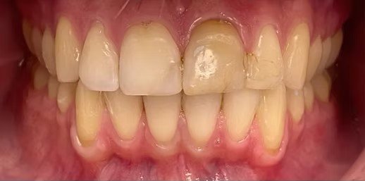 smile-makeover-before-after-10 (1) smile-makeover-before-after-10 (1)