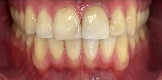 smile-makeover-before-after-10 (2)