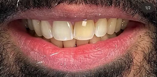 smile-makeover-before-after-3 (5) smile-makeover-before-after-3 (5)