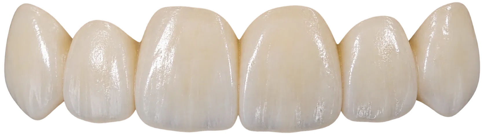 Composite Veneers