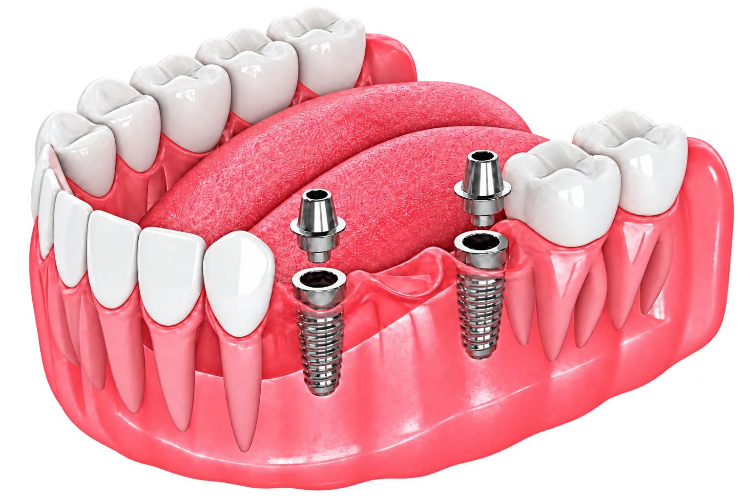 Dental implant abutment