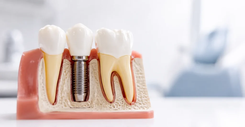 Understanding Dental Implant Costs in NYC