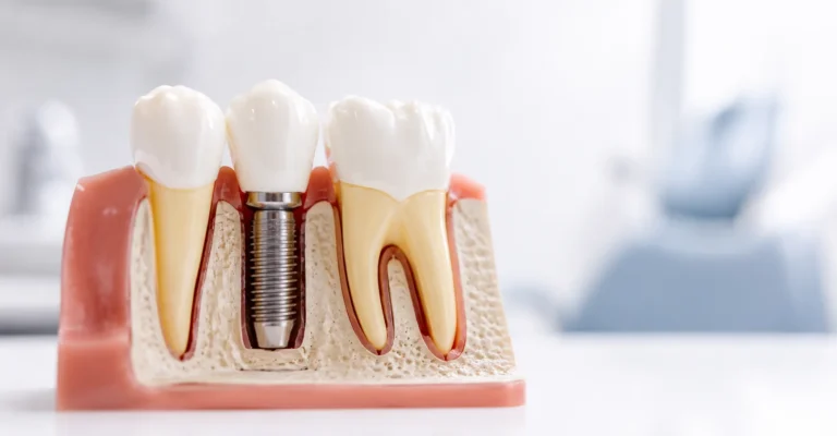 Understanding Dental Implant Costs in NYC