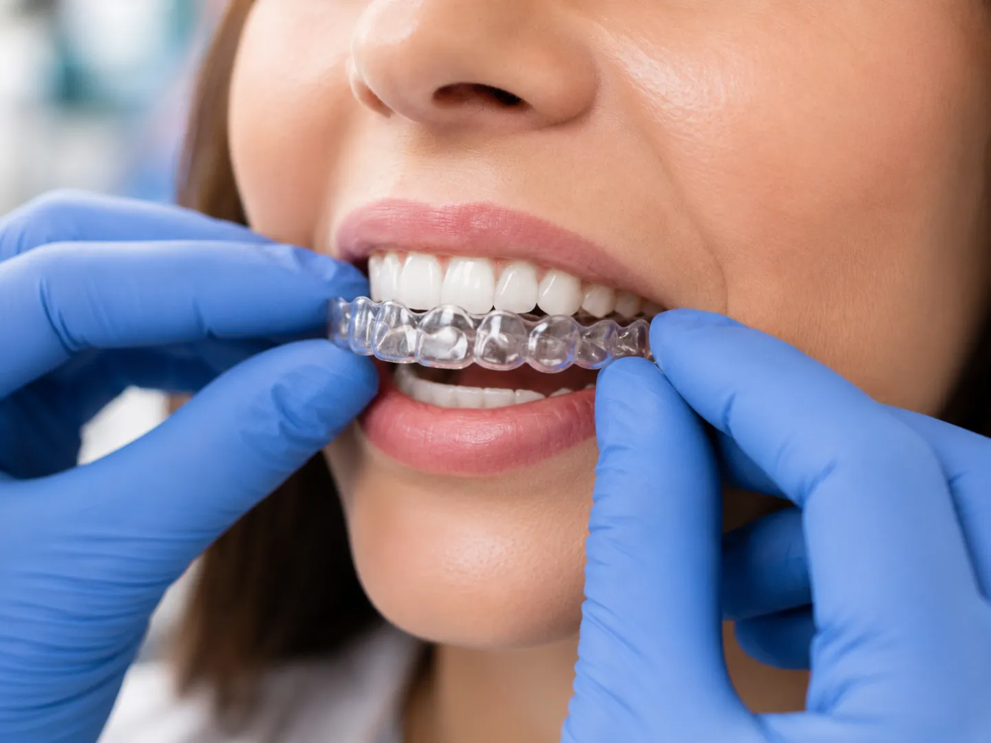 Invisalign clear aligner treatment