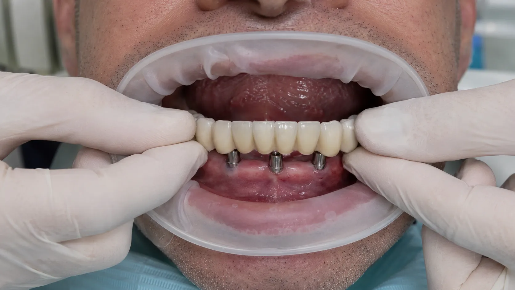 Temporary fixed teeth after implant treatment